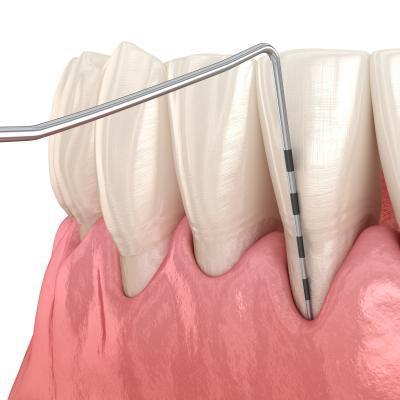 치과에서 절대 말해주지 않는다는 가성비 치료, 잇몸치료